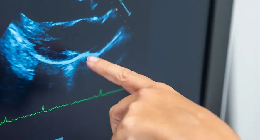 ultrasound image displayed on a monitor
